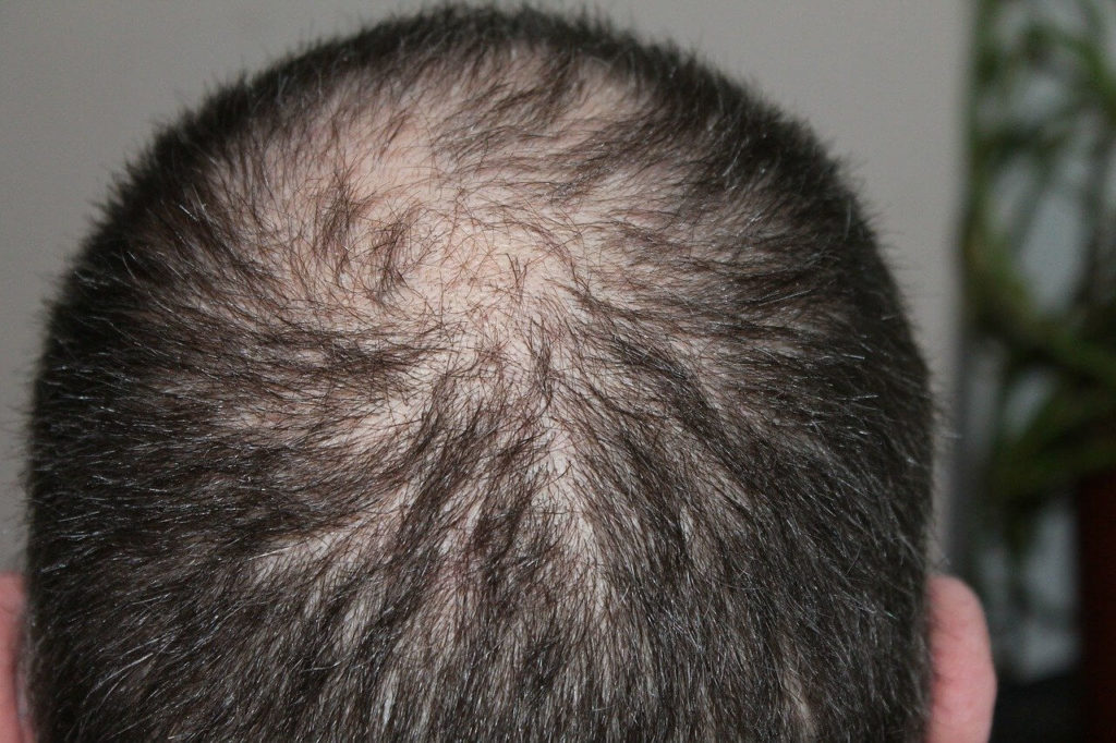 Serum przeciw wypadaniu włosów dla mężczyzn - dlaczego warto?